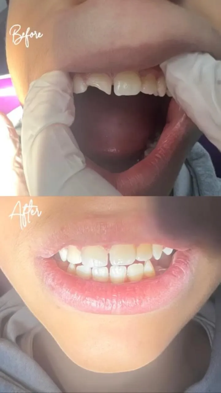 Résultat esthétique dentaire - cas réel