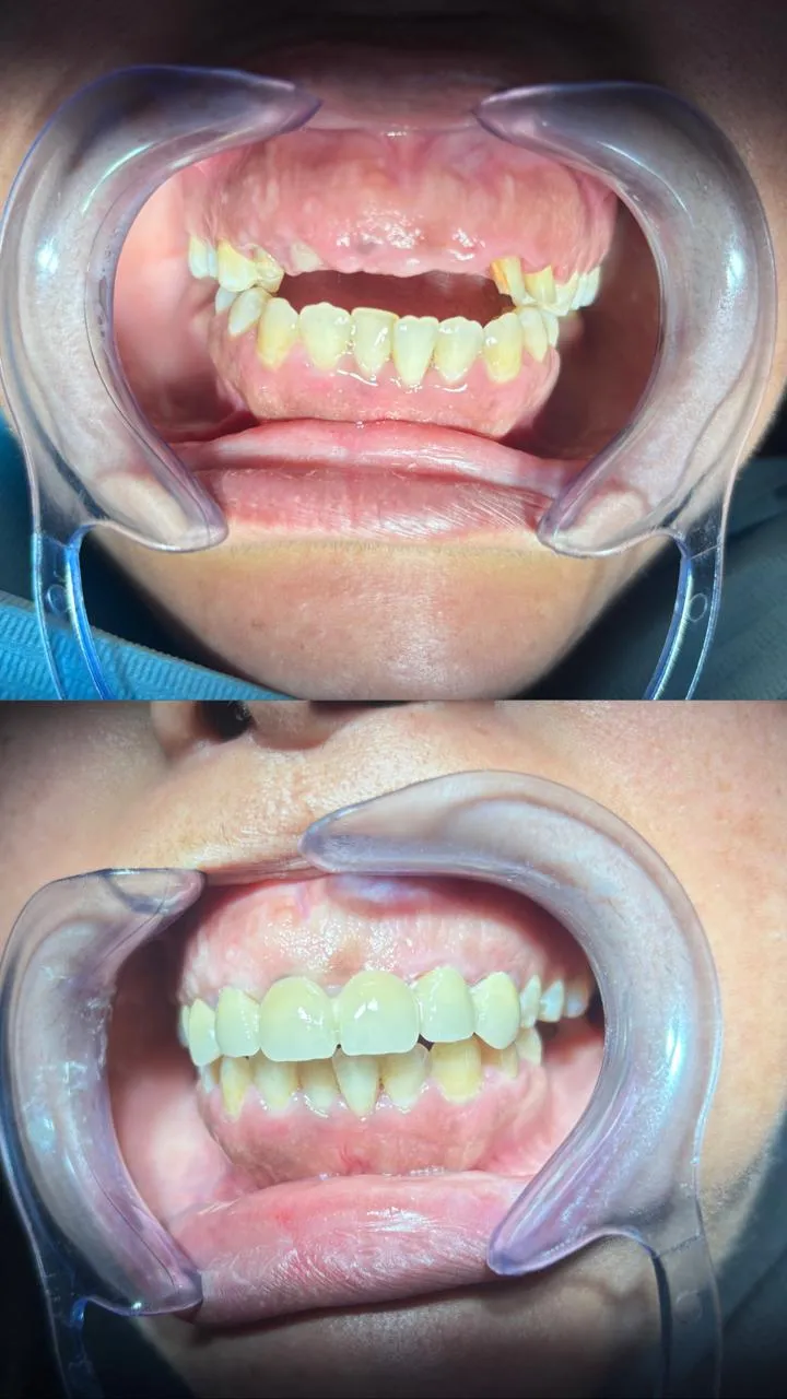 Cas de réhabilitation dentaire