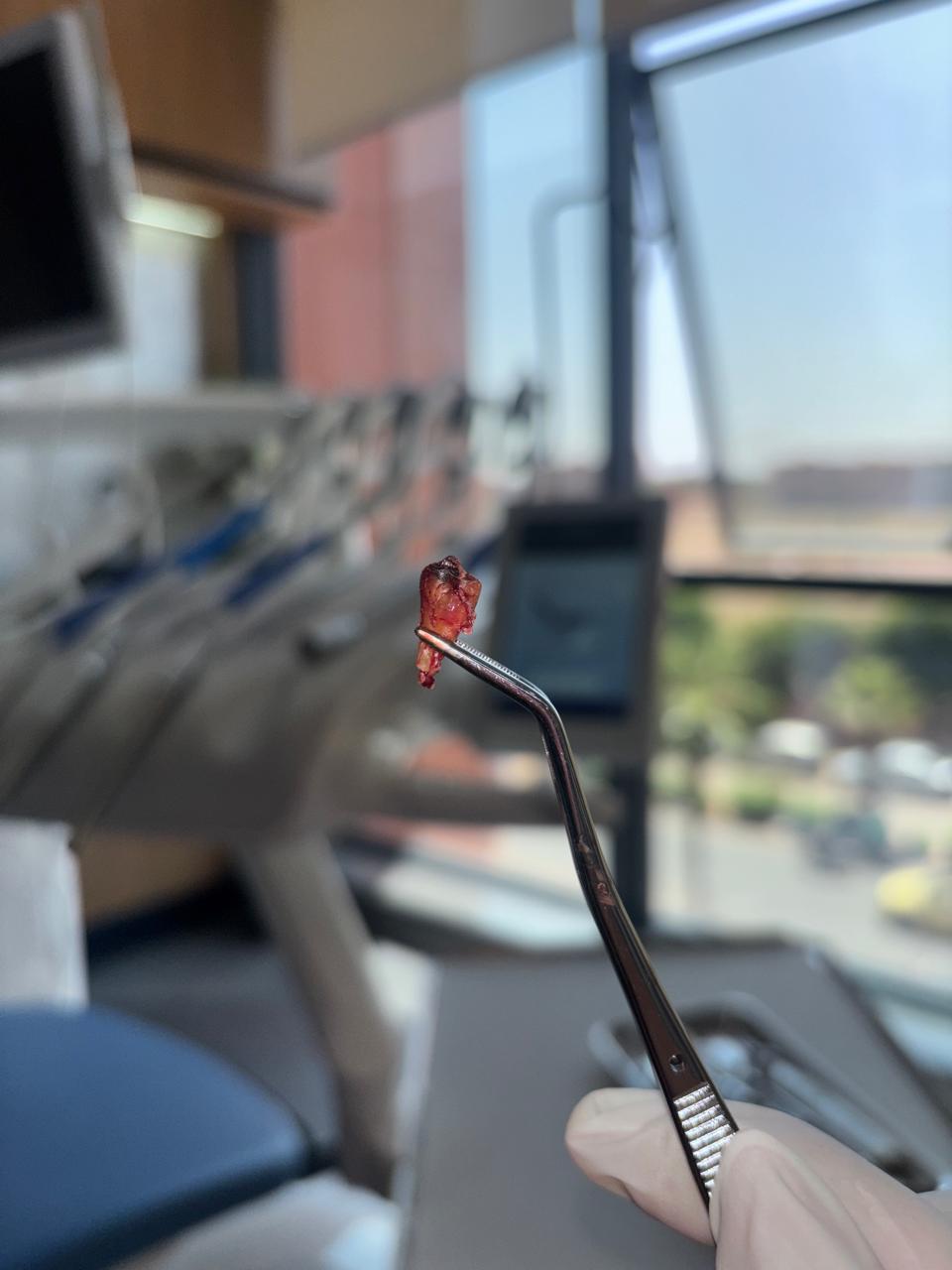 Intervention precise