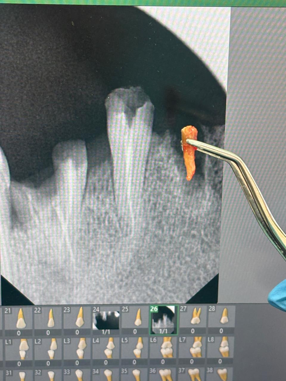 Radiographie et traitement